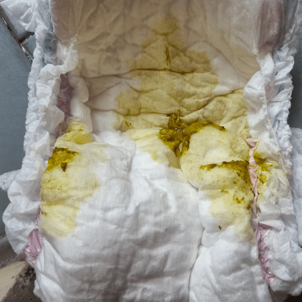 White Poop In Toddler